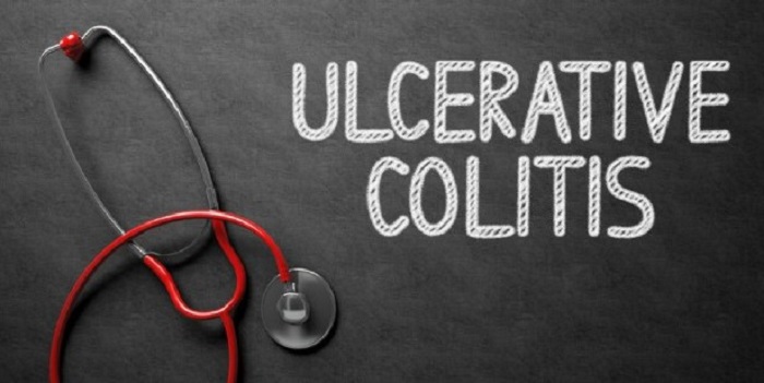colostrum ulcerative colitis