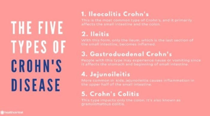 types of colostrum ulcerative colitis (3)